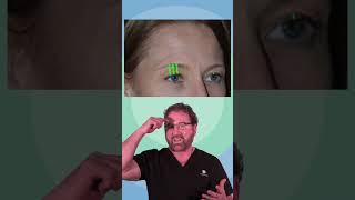 Does endoscopic brow lift raise the forehead [upl. by Aderfla]