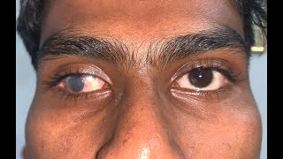 Lost eye treatment Patient Regaining Confidence with a Custom Prosthetic Eye 👁️✨ [upl. by Karilynn108]