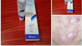 How to use Duac Gell for acne Best Gell for Acne remove Informative video for Acne treatment [upl. by Notniuq194]