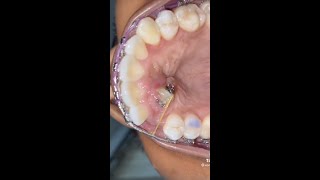 Tooth Stuck on Roof of Mouth 😳 Orthodontist Reacts and Explains Expose  Bond of Impacted Canine [upl. by Bloch]