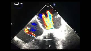 Para valvular versus trans valvular leak to drahmadmirdamadisicUcsbhOAVuyi4L6y [upl. by Nessi617]