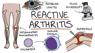 Understanding Reactive Arthritis [upl. by Pesek]