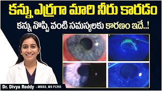 నల్ల గుడ్డుపై గాయం  Symptoms and Treatment of Recurrent Corneal Erosion  Best Vision Eye Hospital [upl. by Tomasina743]