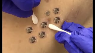 Extreme Blackhead Extraction From Back [upl. by Annawak]