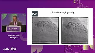 A hybrid approach in complex PCI can DES and DCB be complementary  AICTAsiaPCR 2023 [upl. by Launamme]