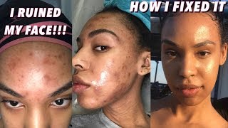 How I RUINED my SKIN chemical burn  hyperpignmentation face peel and how I cleared it [upl. by Malvina]