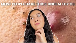 How To Treat Every Type of Acne Comedones Nodules Cysts [upl. by Gareri]