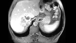 Retroperitoneal Liposarcoma [upl. by Ardnalahs519]