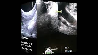 Pelvic Ultrasound Scan [upl. by Allie569]