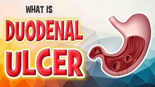 What is a duodenal ulcer ulcus duodenum  Cause Symptoms and Treatment [upl. by Memory]