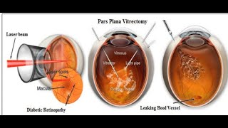 vitrectomy for floaters  recovery day 5  other peoples vlogs reference [upl. by Kaliski]