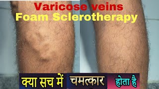 Miracle of foam Sclerotherapy for varicose veins Varicose veins treatment in Ranchi for SSC GD [upl. by Attiuqaj]