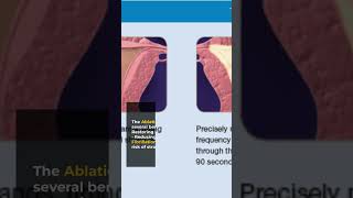 Painless Pulmonary Vein Isolation Your Ultimate Guide to Atrial Fibrillation Ablation [upl. by Hurty]