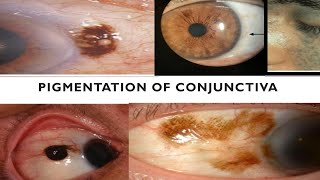 PIGMENTATIONS OF CONJUNCTIVA  Are they cancerous [upl. by Juta]