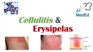 Cellulitis vs Erysipelas  Bacterial Causes Risk Factors Signs and Symptoms Treatment [upl. by Cristiona47]