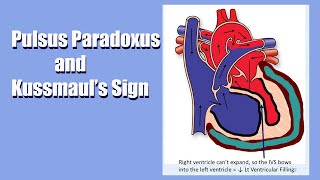 Pulsus Paradoxus amp Kussmauls Sign A Sign of Heart Trouble A Live Lecture [upl. by Aihsel436]