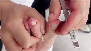 Satisfying ingrown toenail removal funny satisfying [upl. by Calli]