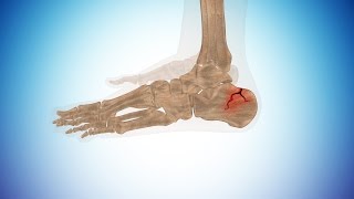 Types of Calcaneus Fracture or Broken Heel [upl. by Oterol]