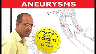 Aneurysms  Causes and Symptoms  Cardiology [upl. by Studdard537]