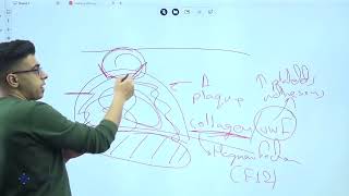 Cardiac pathology  Myocardial infarction [upl. by Berey]