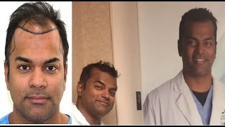 LIVE VIDEO of Hair Transplant in India at Medispa by Dr Suneet Soni Jaipur amp Delhi [upl. by Gnilrits]