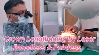 capping of teeth crown Lengthening by Laser Bloodless amp Painless [upl. by Wendi]