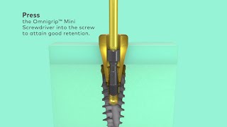 How to remove Nobel Biocare N1 abutments [upl. by Imotas]