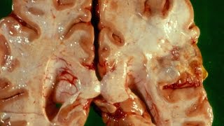 Cerebral Ischaemia and Infarction  Pathology mini tutorial [upl. by Sirovaj]