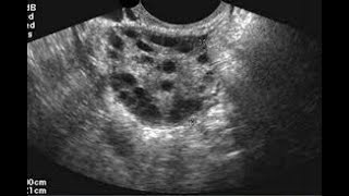 ADENOMIOSIS POR ECOGRAFÍA ADENOMIOSIS SIGNOS Y SÍNTOMAS TX ECOGRAFÍA DE ÚTERO ECOGRAFÍA PÉLVICA [upl. by Kearney201]