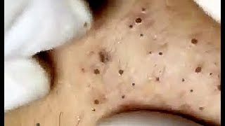 Amazing Blackheads just wait for it [upl. by Telimay]