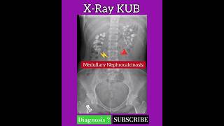 Medullary Nephrocalcinosis  Diagnosis   X Ray KUB  Radiology [upl. by Ripley449]