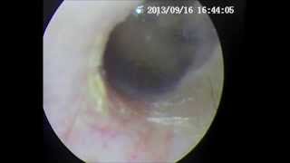 Ear examination by using adroVision V70 medical endoscope system [upl. by Uht]