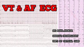 VENTRICULAR TACHYCARDIA amp ATRIAL FIBRILLATION ECG CRITERIAPATIENT FEATURESMT CCU [upl. by Ahsiral836]