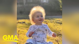 Oneyearold boy has extremely rare ‘uncombable hair syndrome’ l GMA [upl. by Nayrb]