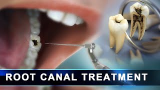 Root Canal Treatment step by step  Curveia Dental Animation in 3D  Endodontics for tooth decay [upl. by Acilegna]