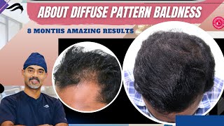 Hair Transplant In Jaipur  Best Clinic Results Surgeon amp Cost of Hair Transplant In Jaipur [upl. by Yeslaehc]