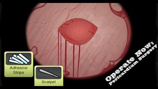 Operate Now Pericardium Surgery Walkthrough [upl. by Haodnanehs]