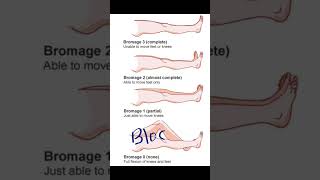 Bromage Score  Anesthesia painmanagement shoreyoutube viral video medical [upl. by Kaule577]