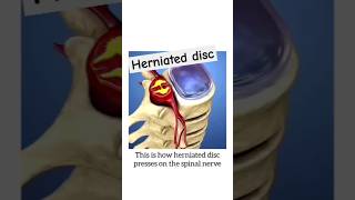 Herniated disc shorts mbbs femalereproductivesystem pregnancy [upl. by Christel840]