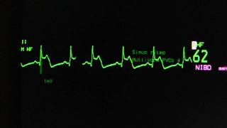 ST elevation on the monitor lead on an ECG monitor [upl. by Gabbey]