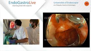 Hemostase endoscopique dun ulcère duodénal hémorragique [upl. by Stoneman323]