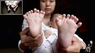 Parents hoping for help after their son is born with 15 fingers and 16 toes [upl. by Karisa812]