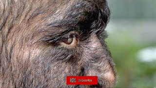 Hypertrichosis What is Werewolf Disease [upl. by Venezia411]