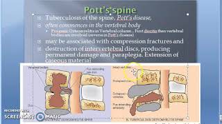 Pathology 825 h TB Spondylitis Tuberculous Osteomyelitis Potts Spine Disease disc body bone [upl. by Enaile867]