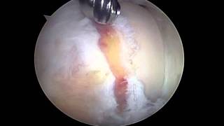 DR MARCUS CRESTANI  artroscopia do quadril Impacto Femoroacetabular tipo Cam [upl. by Peednas]