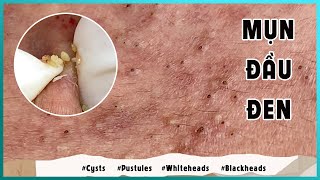 Big Cystic Acne Blackheads Extraction Blackheads amp Milia Whiteheads Removal Pimple Popping [upl. by Oeram]