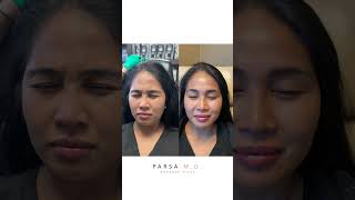 Xeomin Results for Crows Feet 11 Lines and Forehead  Dr Kami Parsa [upl. by Weidman]