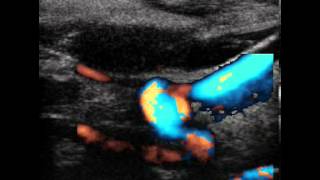 INTERNAL CAROTID ARTERY SPONTANEOUS DISSECTION [upl. by Enirahtac155]