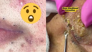 Pimple Popping Paradise A Satisfying Compilation [upl. by Immot]