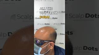 Best solution for baldness 💯scalp micropigmentation scalpmicropigmentationindia smp [upl. by Waine971]